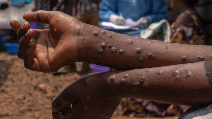 Mpox, maladie qui attaque la peau
